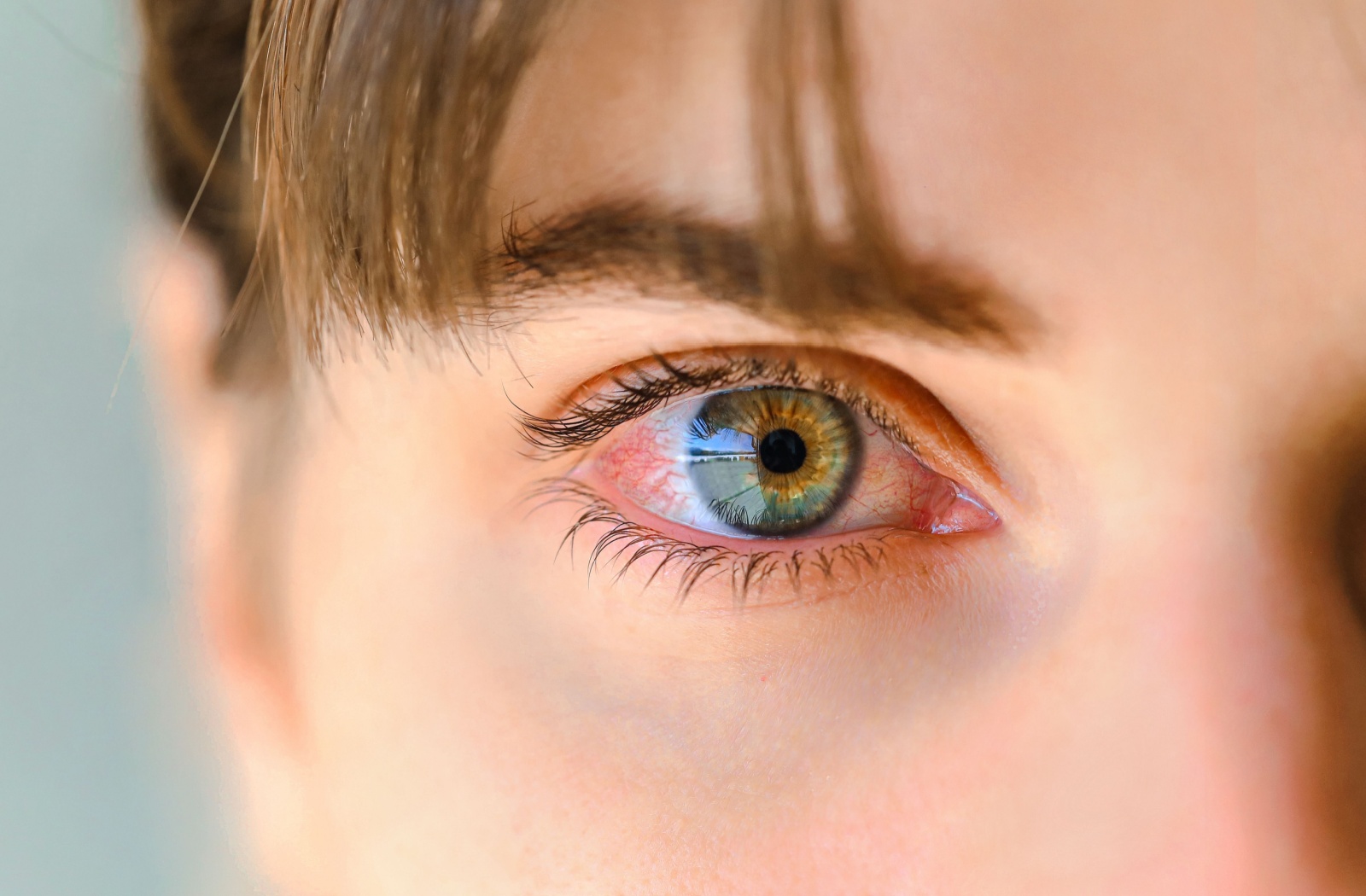 Close-up of an eye with visible redness and irritation.