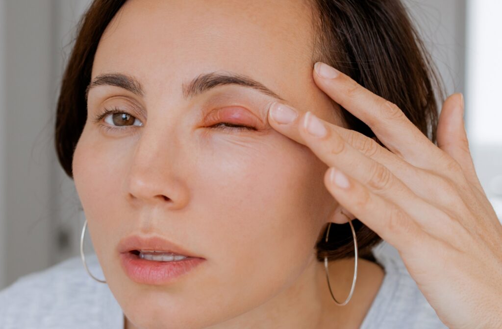 Person looking in a mirror with a visible stye on their eyelid, a condition often mistaken for pink eye.
