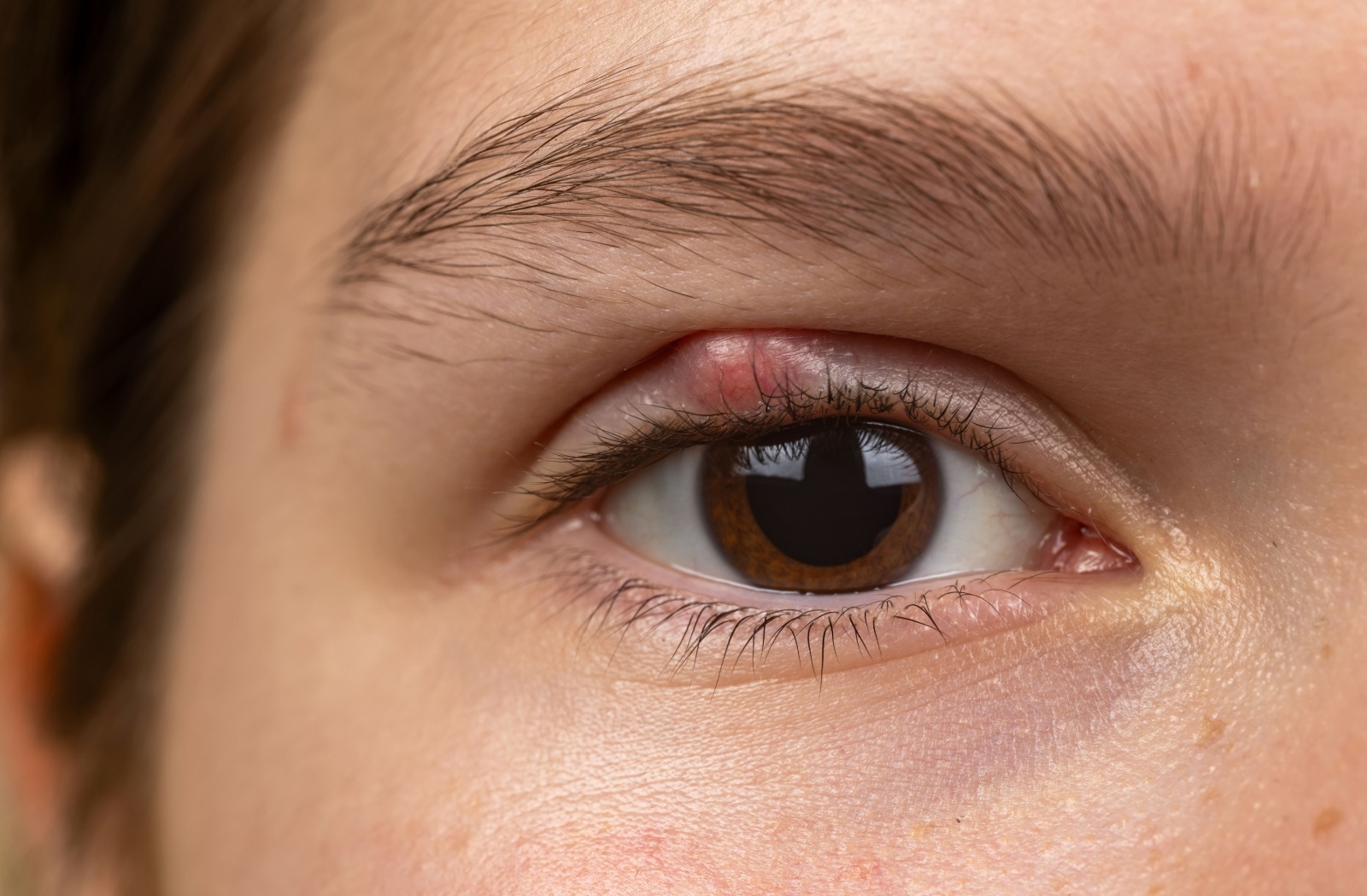 A close-up of an eye with a red, swollen bump on the upper eyelid, showing a visible sign of blepharitis.