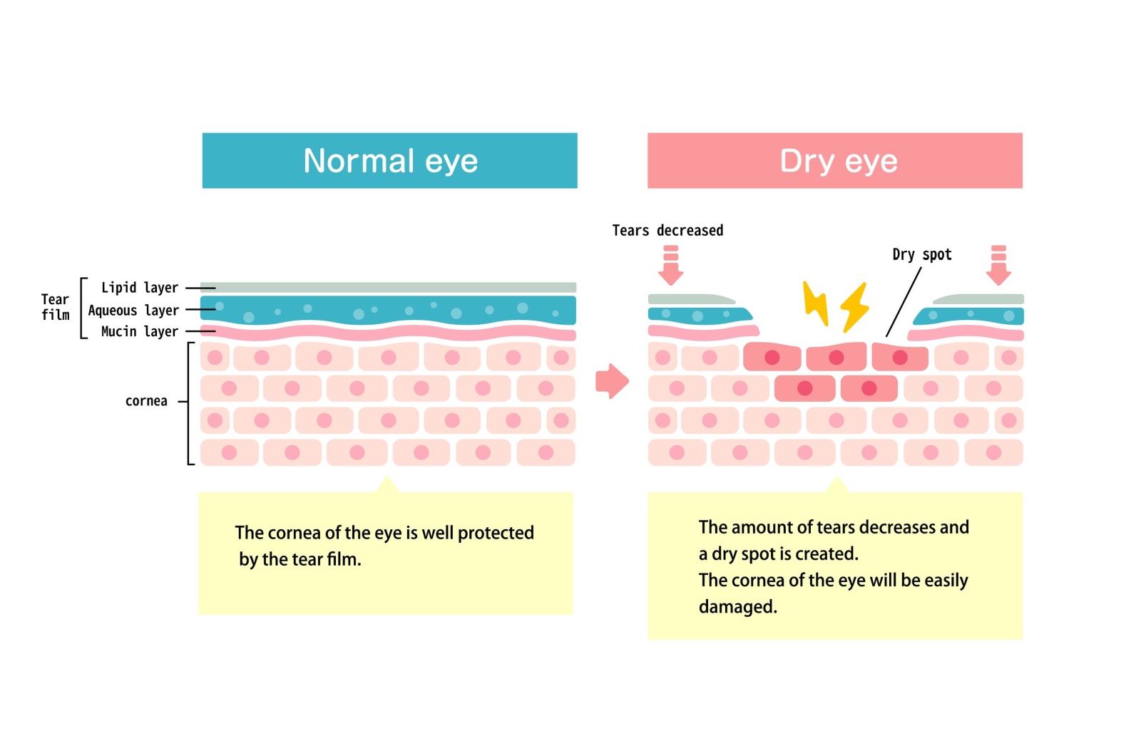 Medical illustration comparing a normal eye and a dry eye, showing the tear film layers and how reduced tears create dry spots and corneal irritation.