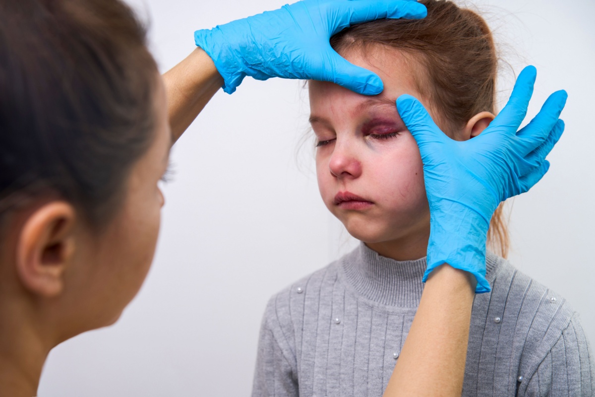 Medical professional in blue gloves examining young child with bruised black eye injury during clinical evaluation.