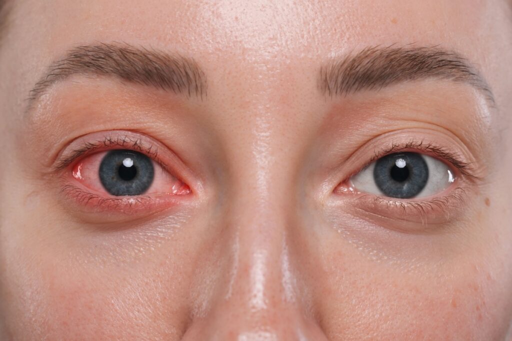 Close up of woman with conjunctivitis in right eye.