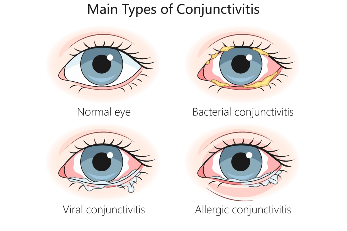 Main types of conjunctivitis.