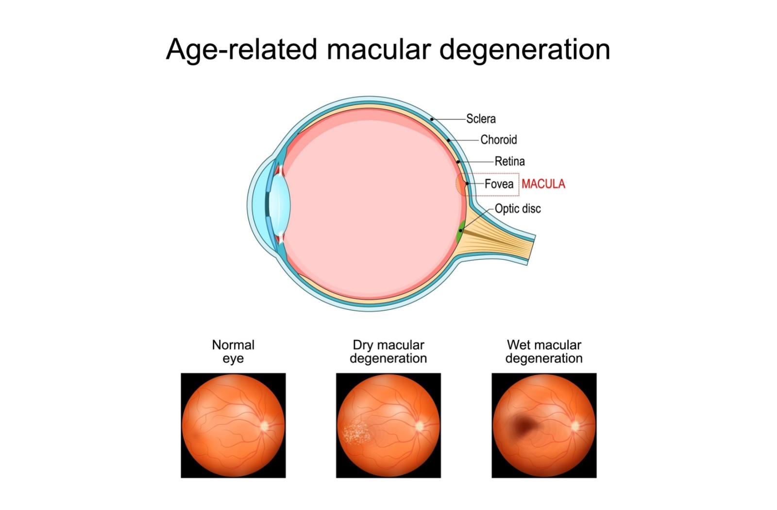 Diagram of the eye highlighting the macula, with three examples below showing a normal retina, dry macular degeneration (mild spots), and wet macular degeneration (dark central blur).